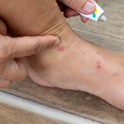 signs you need flea pest control fort mill sc BUGSBGONE